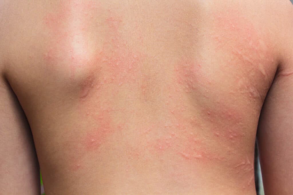 Keto Rash: Reasons and Healthy Ways to Avoid It during Your Diet